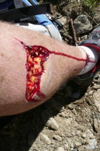 leg bleeding